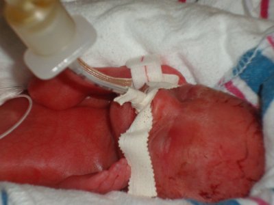 First Photo in the NICU